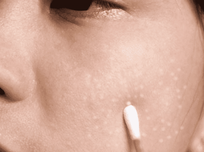 Как избавиться от жировиков на лице в домашних условиях? Как избавиться от жировиков на лице в домашних условиях?