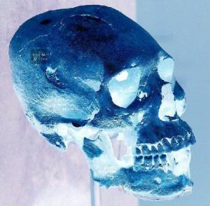 Как выглядит череп бойца MMA после боя. Чемпион показал свой рентген, и кости на нём словно принадлежат мумии